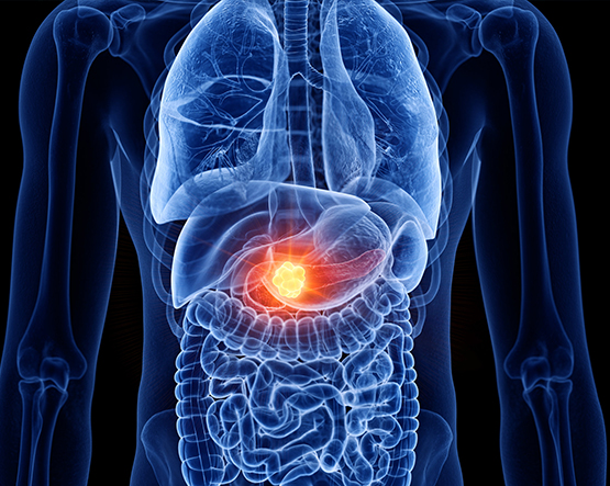 Pancreatic cancer
