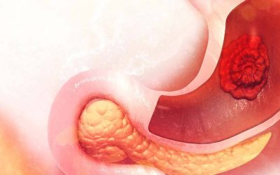 Ideal Lifestyle Practices for Stomach Cancer Treatment