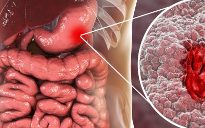 All About Gastric Cancer (Stomach Cancer)