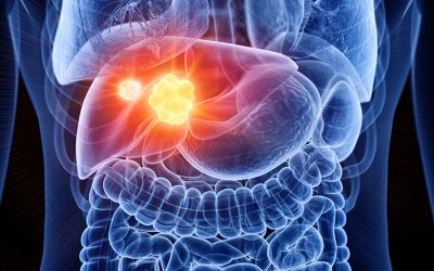 Colorectal Liver Metastasis