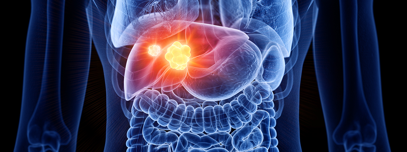 Colorectal Liver Metastasis