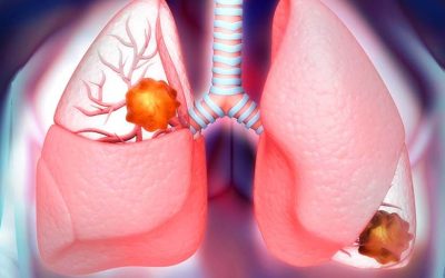 Understanding Gastric Cancer Treatment in Mumbai: Prevention and Treatment