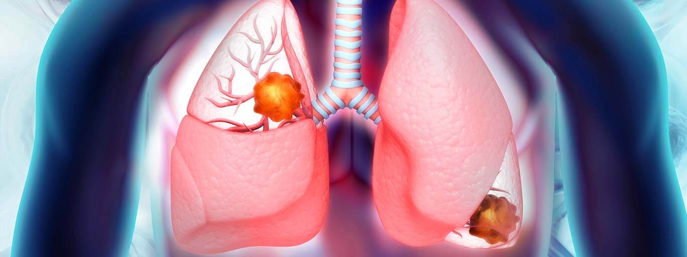 stomach cancer-prevention treatment