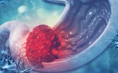 What are the Symptoms of Stomach Cancer? Is it Curable?