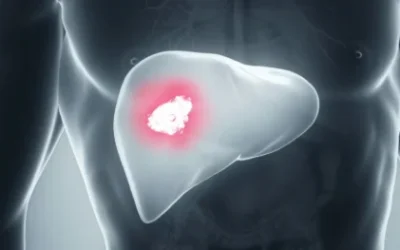 Understanding Liver Cancer Treatment in Mumbai and Its Causes: Insights from Dr. Ganesh Nagarajan