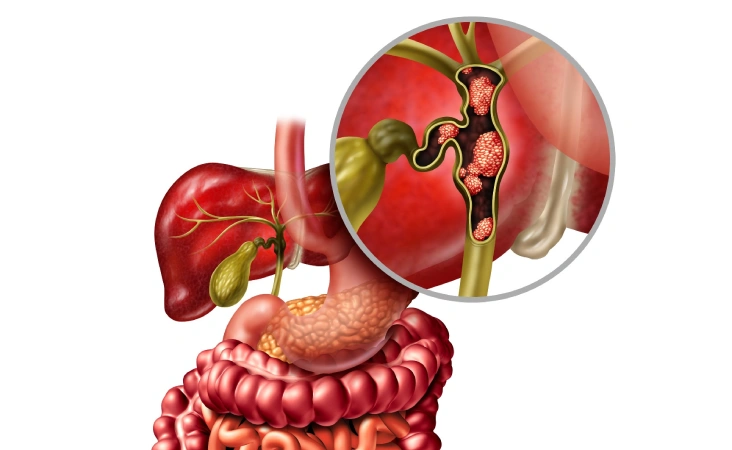 Bile Duct Cancer Treatment in Mumbai, India