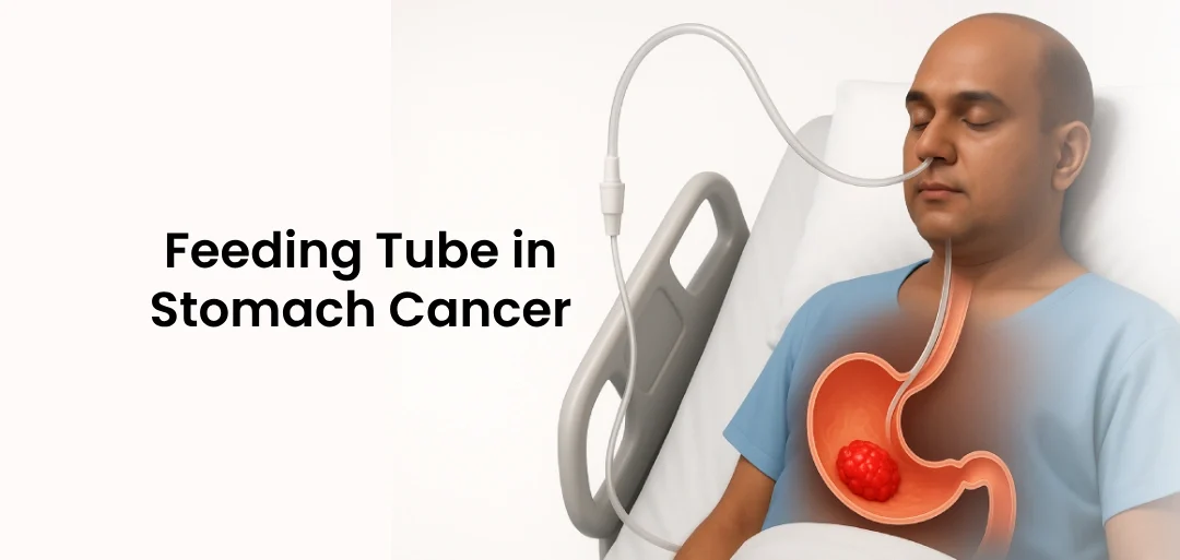 Feeding Tube in Stomach Cancer: How it supports Patients Through Care?