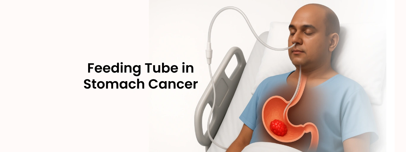 Feeding Tube in Stomach Cancer