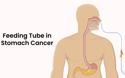 Feeding Tube in Stomach Cancer