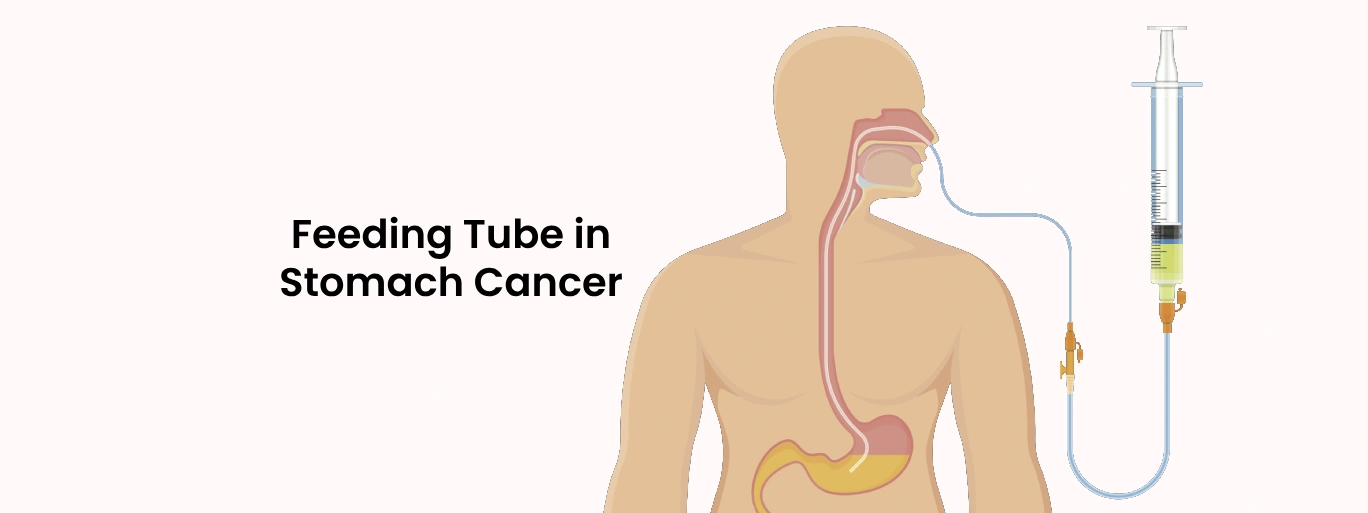 Feeding tube in stomach cancer